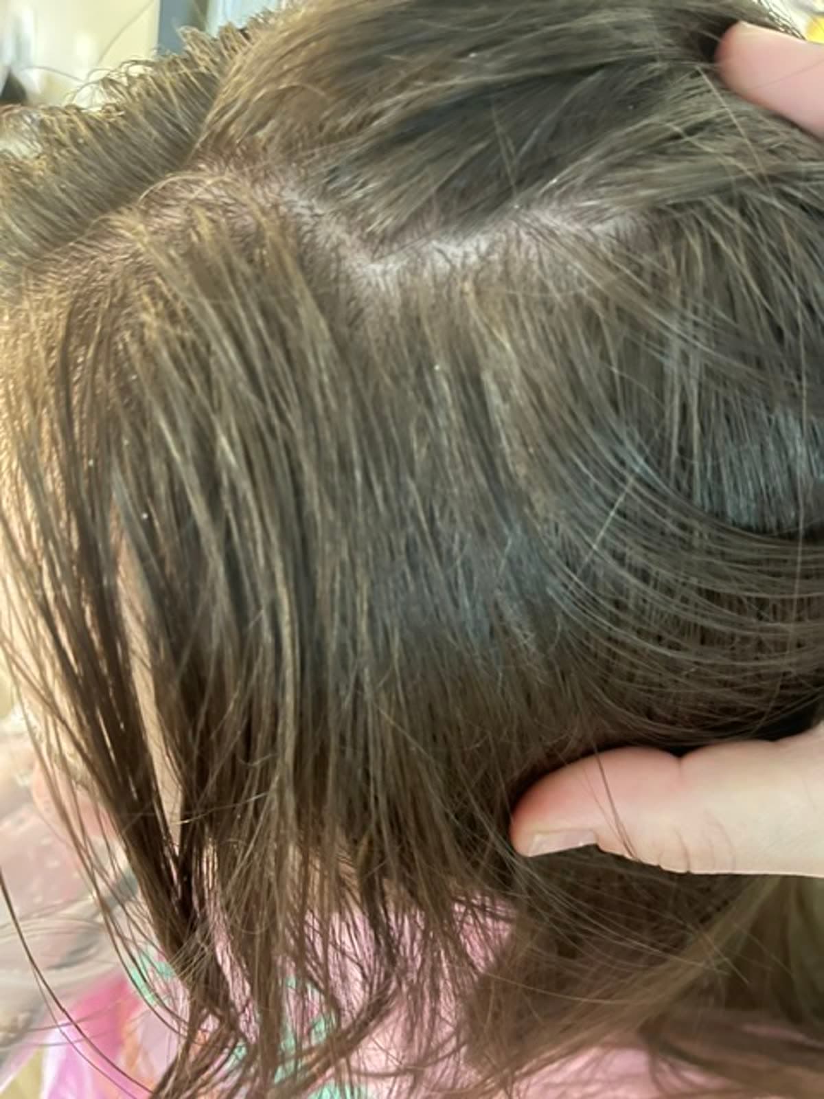 Scalp before using Max Control shampoo — visible dandruff and flakes